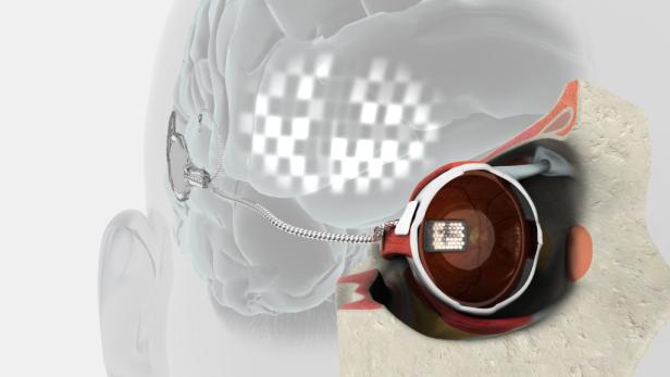 epa03374812 An undated computer generated handout image made available by Bionic Vision Australia on 30 August 2012 shows an early bionic eye prototype drawing. A vision impaired Australian woman, Dianne Ashworth, has successfully had the prototype of a b