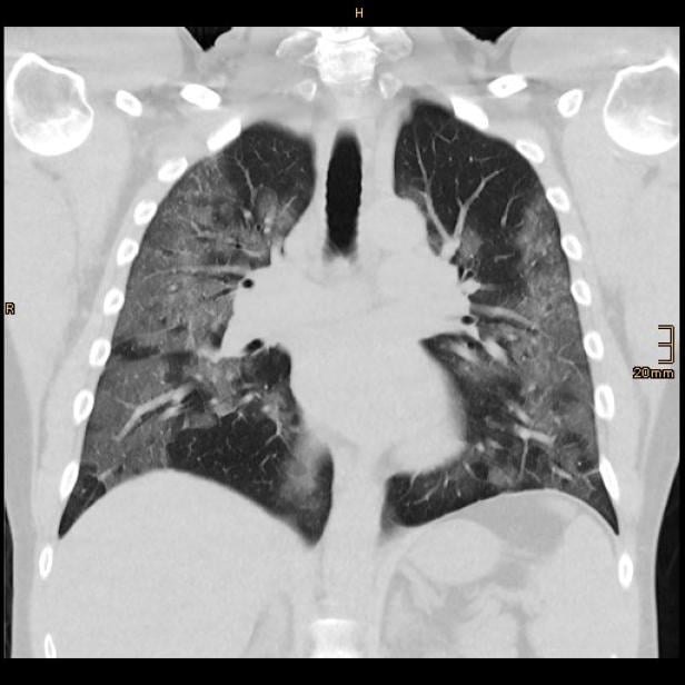 The lungs of 48-year-old coronavirus disease (COVID-19) patient Andre Bergmann