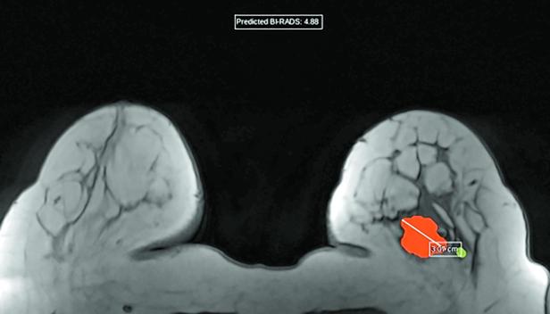 Ein MRT-Scan der Brust zeigt einen rot markierten Bereich mit einer Größe von 3,68 cm.