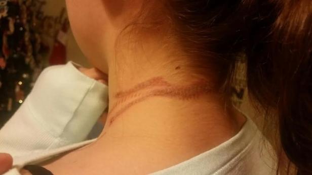 Die Verbrennungen am Hals wurden von den Eltern des Mädchens dokumentiert