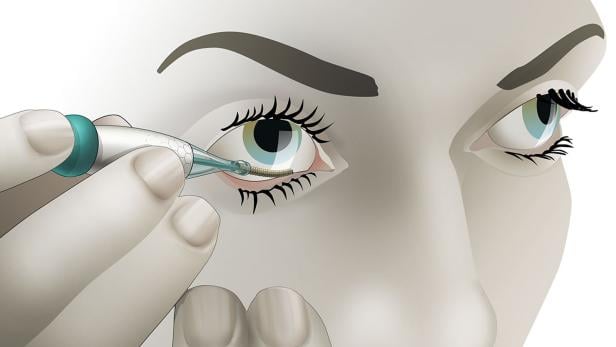 Ein Gerät wird verwendet, um eine medizinische Vorrichtung in das Auge einer Person einzusetzen.
