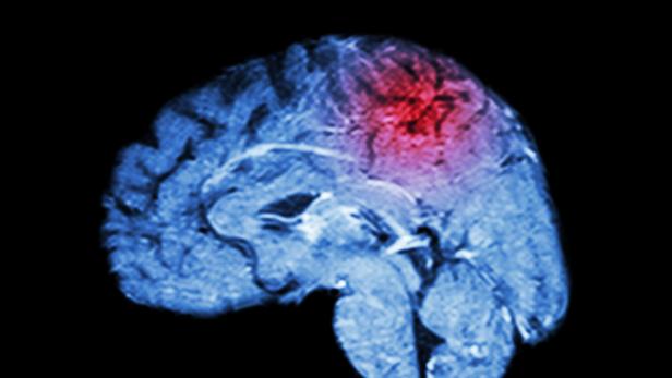 Magnetic Resonance Imaging ( MRI ) of brain and Stroke