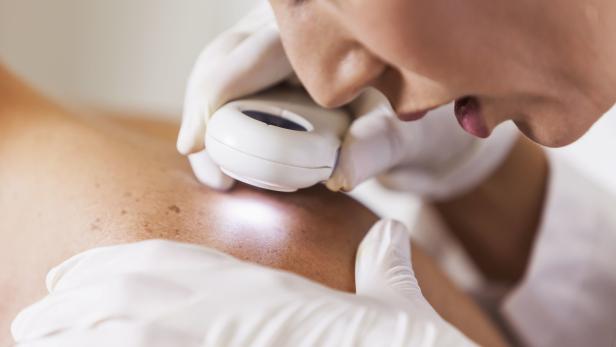 Eine Hautärztin untersucht mit einem Vergrößerungsglas Haut. 