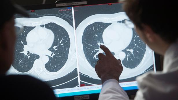CT-Bilder einer Lunge: „Es ist spannend und beeindruckend, was sich bei den Therapien tut“, sagt Lungenkrebsspezialist Maximilian Hochmair.