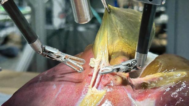 Roboter-Greifarme packen eine Gallenblase