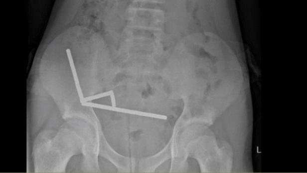 Die Magnete haben sich im Darmtrakt verbunden.