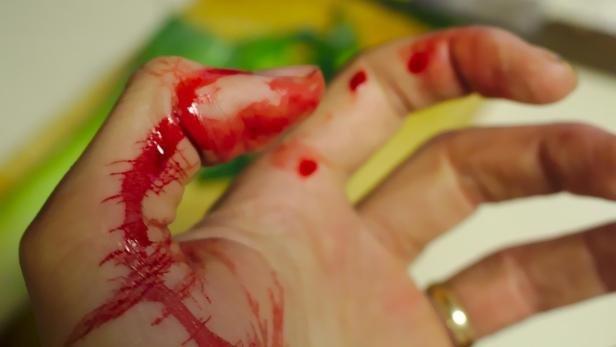 Eine blutende Wunde an der Hand