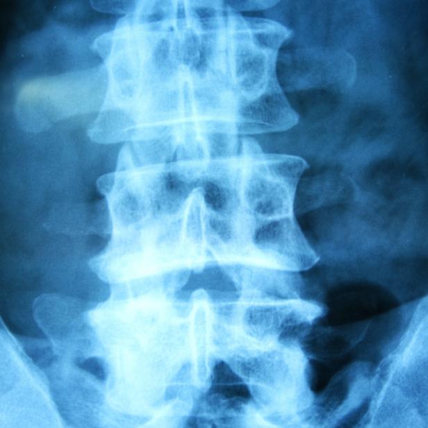 Ein Röntgenbild der Lendenwirbelsäule und des Beckens.