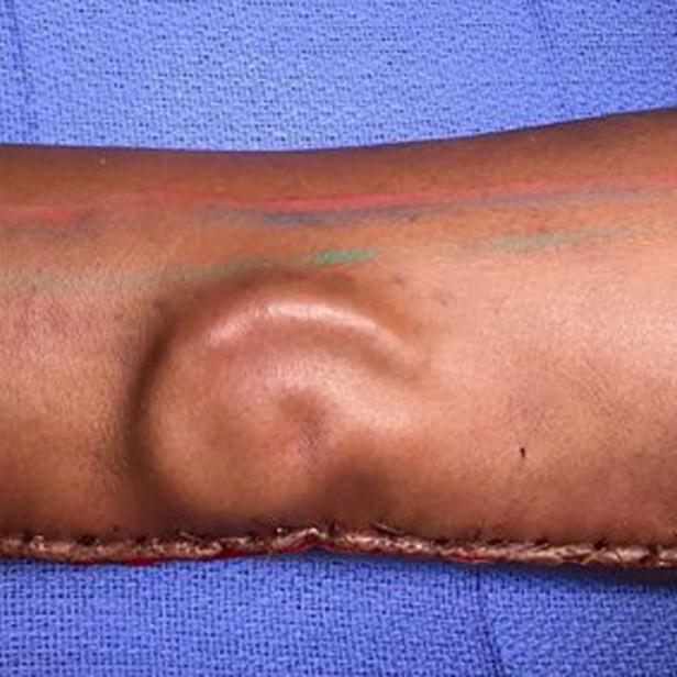 Ein Arm mit einer Operationsnarbe und einer deutlichen Schwellung.