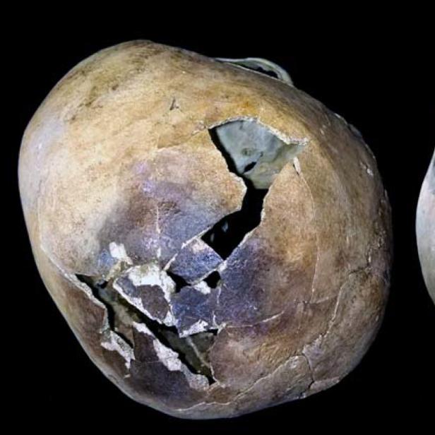 Zwei menschliche Schädel, einer davon mit einem großen Loch.