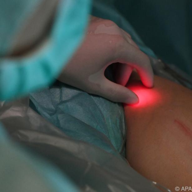 Krampfadern können auch per Laser therapiert werden