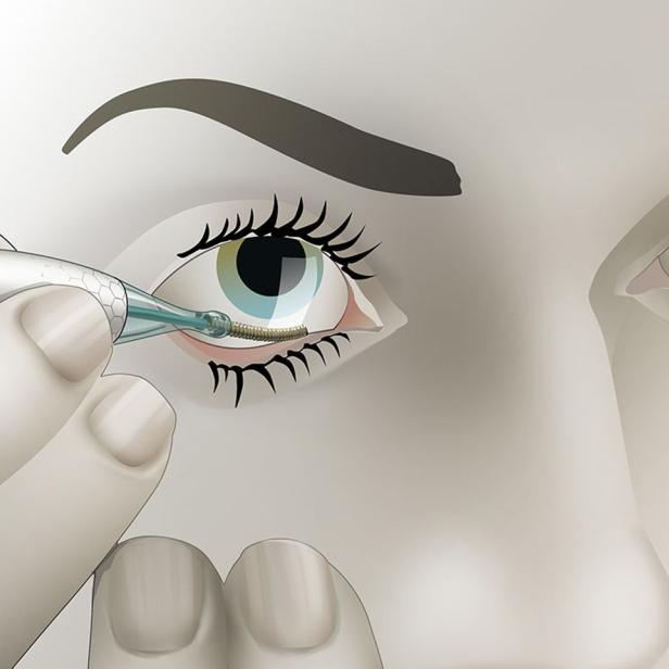 Ein Gerät wird verwendet, um eine medizinische Vorrichtung in das Auge einer Person einzusetzen.