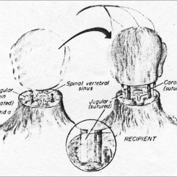 Kopftransplantation: Skizze von Sergio Canavero