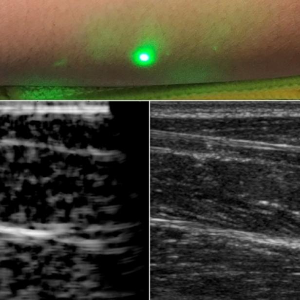 Laser-Ultraschall des MIT in der Anwendung