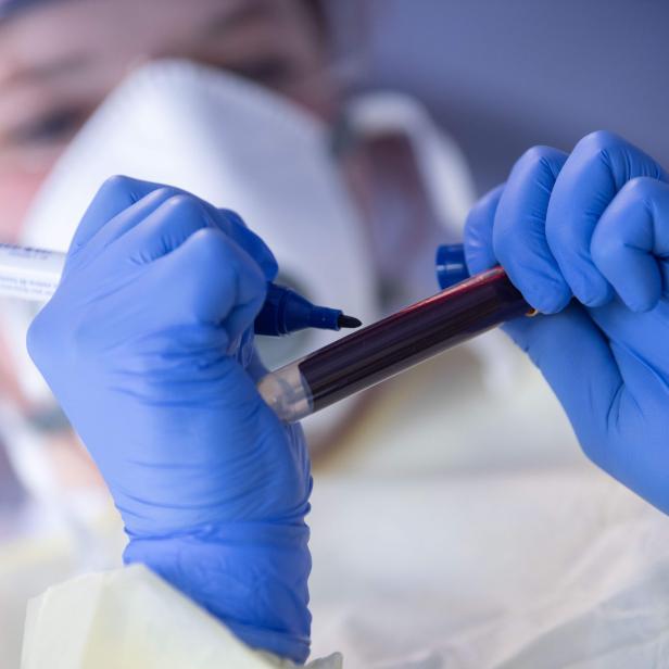 Eine medizinische Fachkraft beschriftet ein Blutprobenröhrchen.