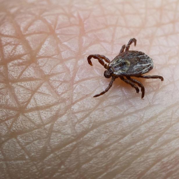 Am häufigsten äußert sich eine Borreliose-Ansteckung in Form der Wanderröte, eine lokale Hautrötung, die unbehandelt immer größer wird.