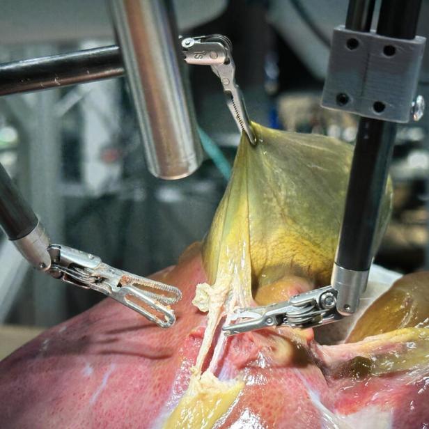 Roboter-Greifarme packen eine Gallenblase