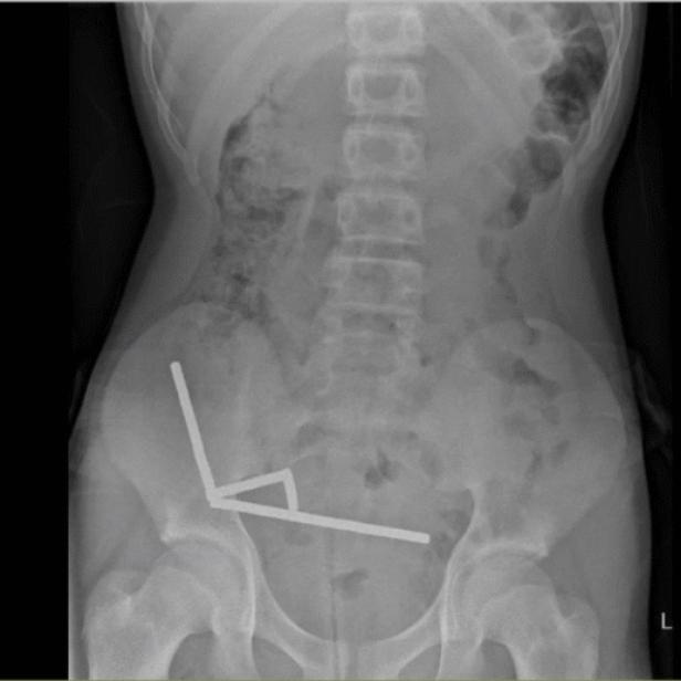 Die Magnete haben sich im Darmtrakt verbunden.